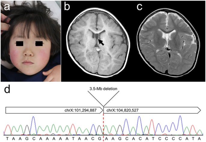 Xq22 deletion involving TCEAL1 in a female patient with early-onset neurological disease trait.