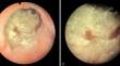 Management of the Devastated Bladder Outlet after Prostate CANCER Treatment.