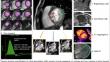 Assessing Regurgitation Severity, Adverse Remodeling, and Fibrosis with CMR in Primary Mitral Regurgitation.