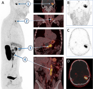 Concomitant metastatic head-and-neck cancer and pancreatic cancer assessed by αvβ6-integrin PET/CT using <sup>68</sup>Ga-Trivehexin: incidental detection of a brain metastasis.