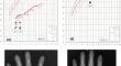 Growth Failure in STAT3 Gain-of-Function Syndrome Persists After Hematopoietic Stem Cell Transplantation.