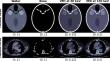 Analysis of Solution Existence, Uniqueness, and Stability of Discrete Basis Sinograms in Multispectral CT