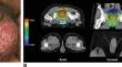 Penile-scrotal erythrodysesthesia among rectal cancer patients receiving fluoropyrimidine-based chemoradiation: a case report series.