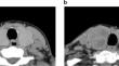 Correlation between the thyroid computed tomography value and thyroid function in hyperthyroidism: a retrospective study.