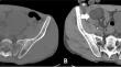 Percutaneous Ablation of T1b Renal Cell Carcinoma: An Overview.