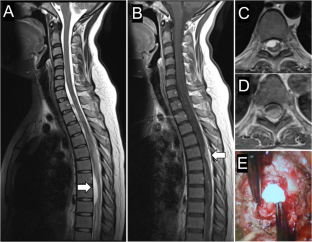 Surgical treatment for recurrent thoracic ventral intradural arachnoid cyst secondary to tuberculous meningitis: a case report.