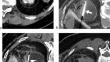 Mimicking Cryoprobe Fracture During Renal Cryoablation Due to Contrast Media Concentration: A Case Report with Verification.