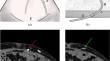 CT data analysis of catheter morphology and displacement in peritoneal dialysis: an exploratory study.