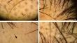 Dissecting hair breakage in alopecia areata: the central role of dysregulated cysteine homeostasis.