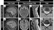 Spinal cord involvement in progressive multifocal leukoencephalopathy and immune reconstitution inflammatory syndrome.