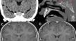 Langerhans cell histiocytosis of the sella in a pediatric patient: case report with review of the literature.