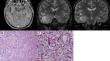 Low-grade glioma of the temporal lobe and tumor-related epilepsy in children.