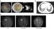 A Novel Homozygous RHOH Variant Associated with T Cell Dysfunction and Recurrent Opportunistic Infections.