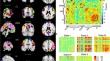 Oral ketamine effects on dynamics of functional network connectivity in patients treated for chronic suicidality.