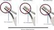 Using preoperative planning software to assess the effect of head length on prosthetic range of motion in a high-risk population: a three-dimensional modeling study.