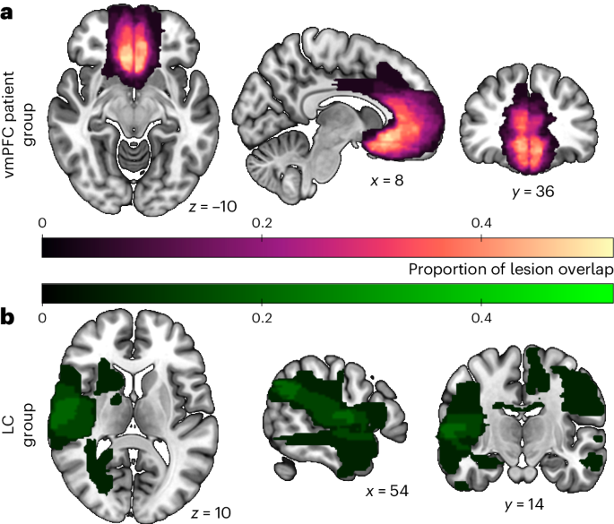 Human ventromedial prefrontal cortex is necessary for prosocial motivation