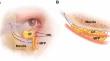 Lower Blepharoplasty with Mid-Face Elevation: A Polydioxanone (PDO) Barbed Suture Loop for Lid–Cheek Junction Blending