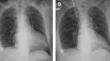 Impella support for refractory cardiogenic shock accompanied by diabetic ketoacidosis: a case report.