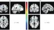 Correlation between White Matter Changes and Clinical Symptoms in Patients with Major Depressive Disorder