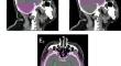 Modulated Arc Therapy for hippocampal-avoidance whole brain radiation therapy: planning comparison with intensity modulated Radiation Therapy.