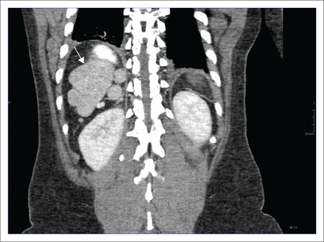 Heterotaxy syndrome - An unusual cause for bowel obstruction in an adult.