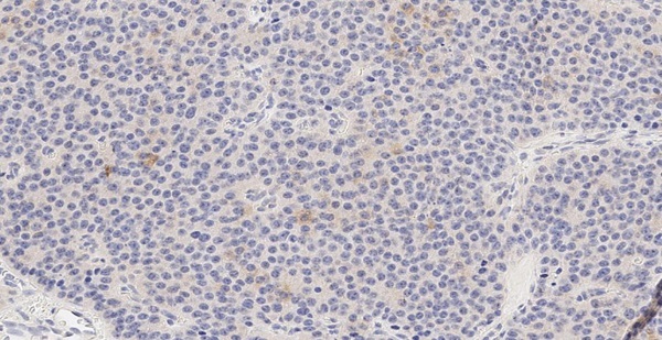 [Search for new immunohistochemical and circulating markers of insulinoma].