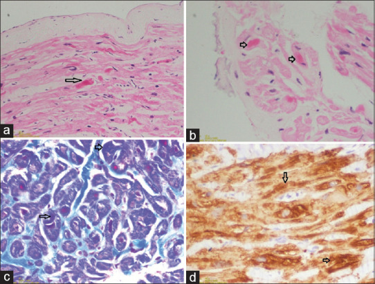Heart failure following cavopulmonary shunt - An unusual story of desmin cardiomyopathy.