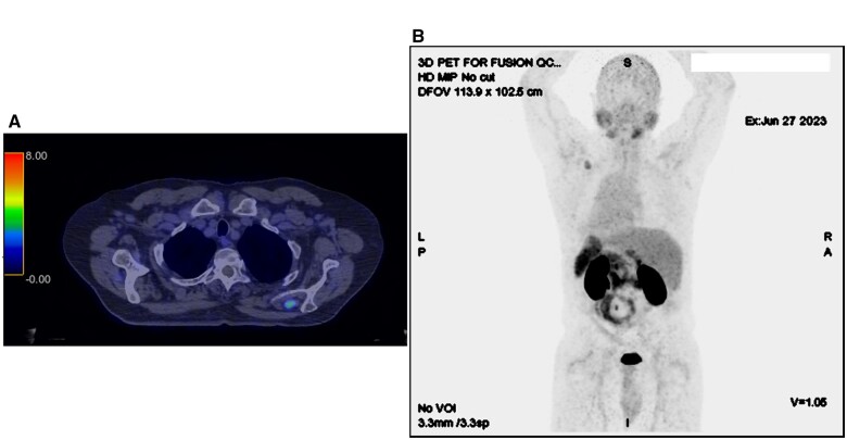 Prostate specific membrane antigen PET avidity in a granular cell tumour of the left supraspinatus muscle: a case report.