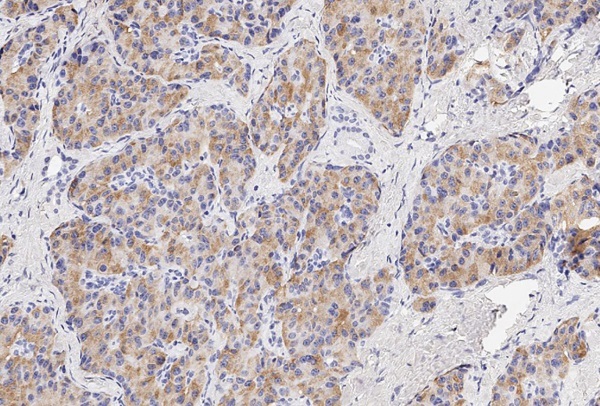 [Search for new immunohistochemical and circulating markers of insulinoma].