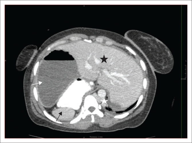 Heterotaxy syndrome - An unusual cause for bowel obstruction in an adult.