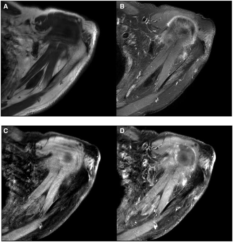 Prostate specific membrane antigen PET avidity in a granular cell tumour of the left supraspinatus muscle: a case report.