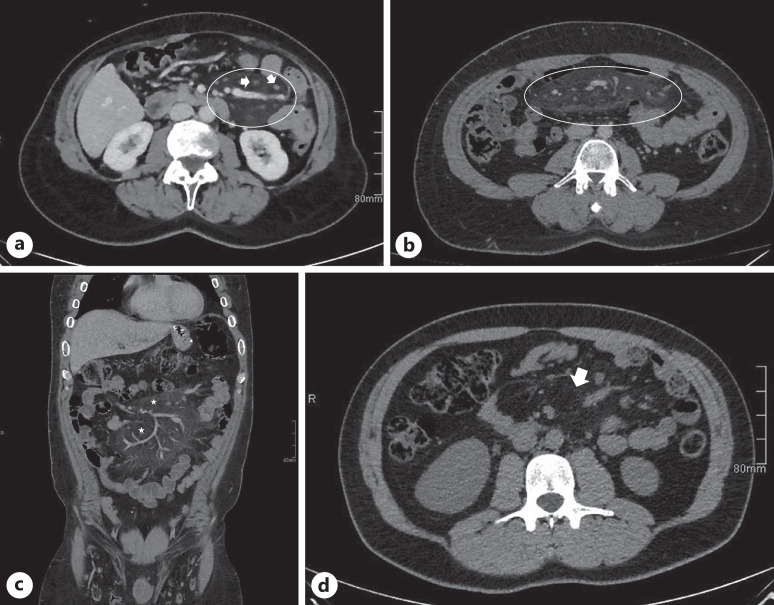 Mesenteric Panniculitis.