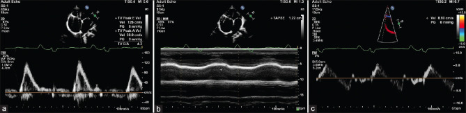 Heart failure following cavopulmonary shunt - An unusual story of desmin cardiomyopathy.