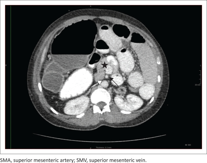 Heterotaxy syndrome - An unusual cause for bowel obstruction in an adult.