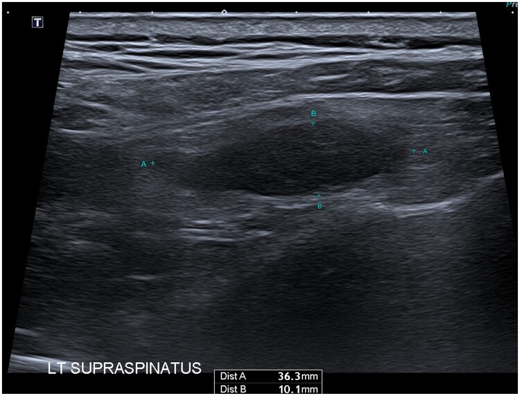 Prostate specific membrane antigen PET avidity in a granular cell tumour of the left supraspinatus muscle: a case report.