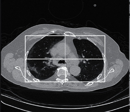 COVID-19 Detection from Computed Tomography Images Using Slice Processing Techniques and a Modified Xception Classifier.