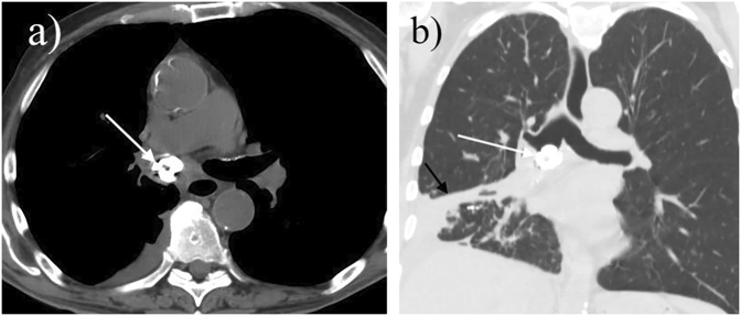 Tracheoesophageal fistula due to Candida and Actinomyces co-infection: A case report and comprehensive review of the literature.