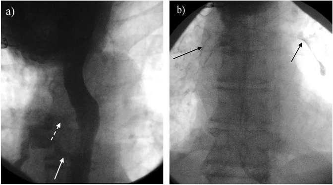 Tracheoesophageal fistula due to Candida and Actinomyces co-infection: A case report and comprehensive review of the literature.