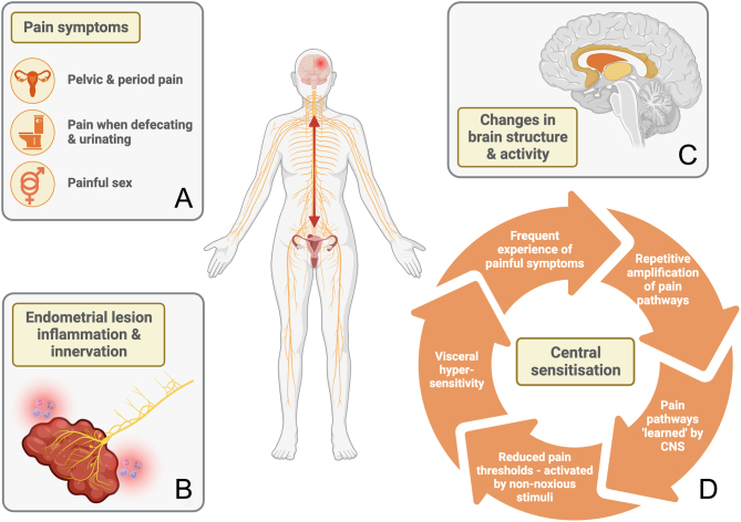 The impact of the microbiota-gut-brain axis on endometriosis-associated symptoms: mechanisms and opportunities for personalised management strategies.