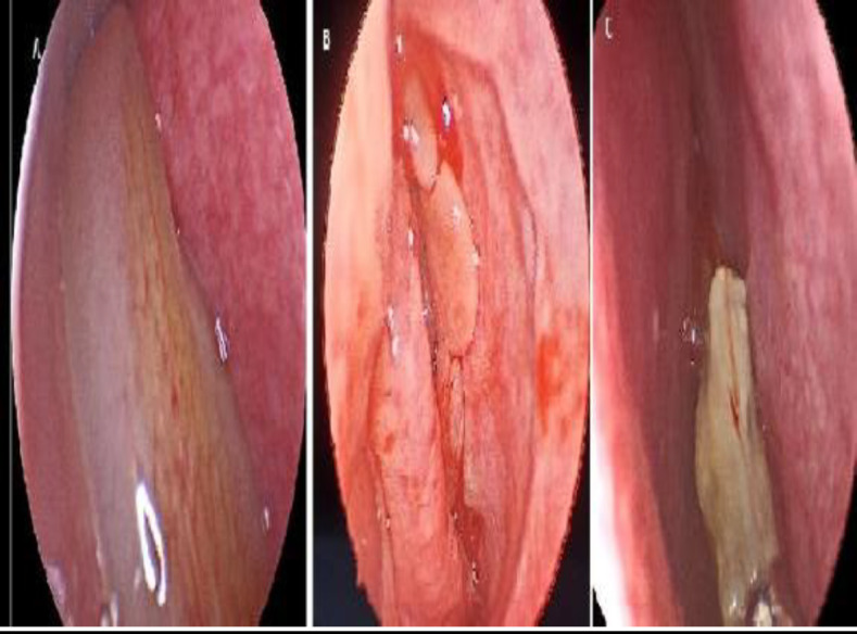 Pediatric Unilateral Chronic Sinusitis: Clinical and Radiological Patterns Compared to Adults.