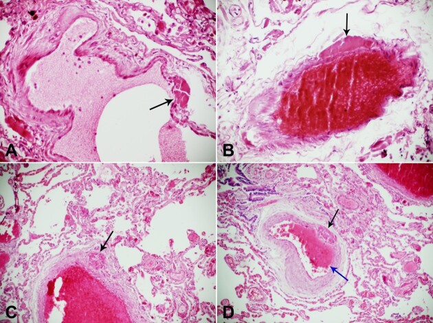 Thrombosis of the vasa vasorum of the large and medium size pulmonary artery and vein leads to pulmonary thromboembolism in COVID-19.