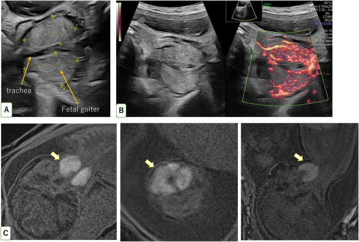 Massive fetal goiter treated by intra-amniotic injection of levothyroxine: a case report.