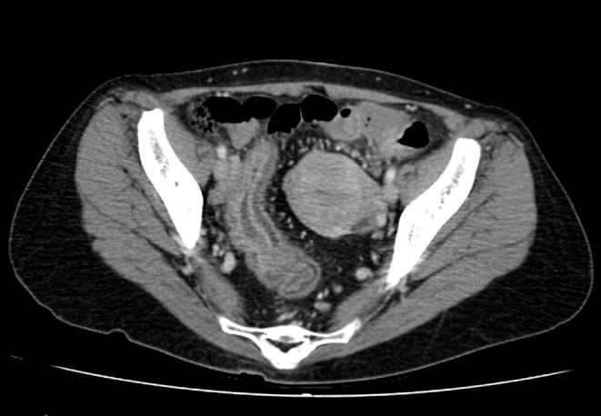 Successful Fistula Closure After Treatment with Colostomy and Infliximab in a Patient with Ulcerative Colitis Complicated by Rectovaginal Fistula.