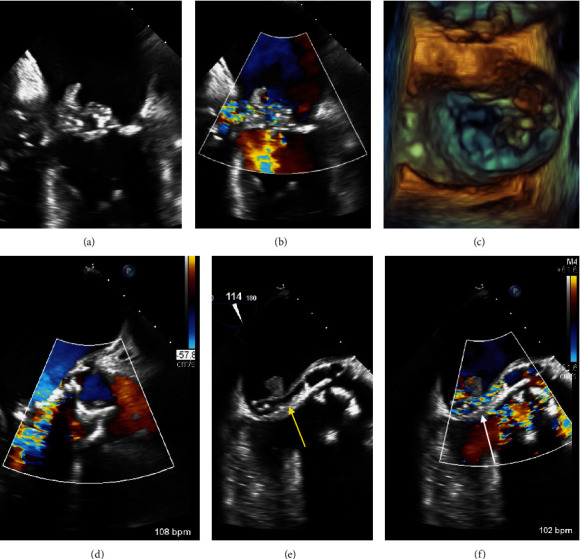 Leveraging Color M-Mode to Diagnose Aorto-Atrial Fistula as a Complication of Infective Endocarditis.