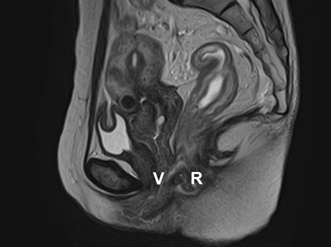 Successful Fistula Closure After Treatment with Colostomy and Infliximab in a Patient with Ulcerative Colitis Complicated by Rectovaginal Fistula.