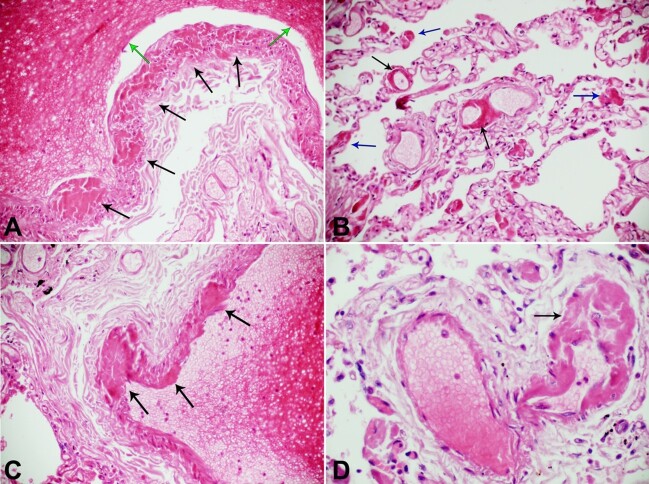 Thrombosis of the vasa vasorum of the large and medium size pulmonary artery and vein leads to pulmonary thromboembolism in COVID-19.