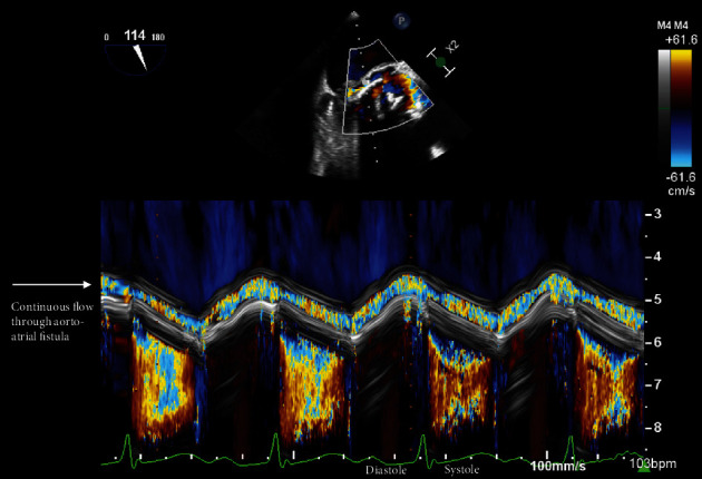 Leveraging Color M-Mode to Diagnose Aorto-Atrial Fistula as a Complication of Infective Endocarditis.