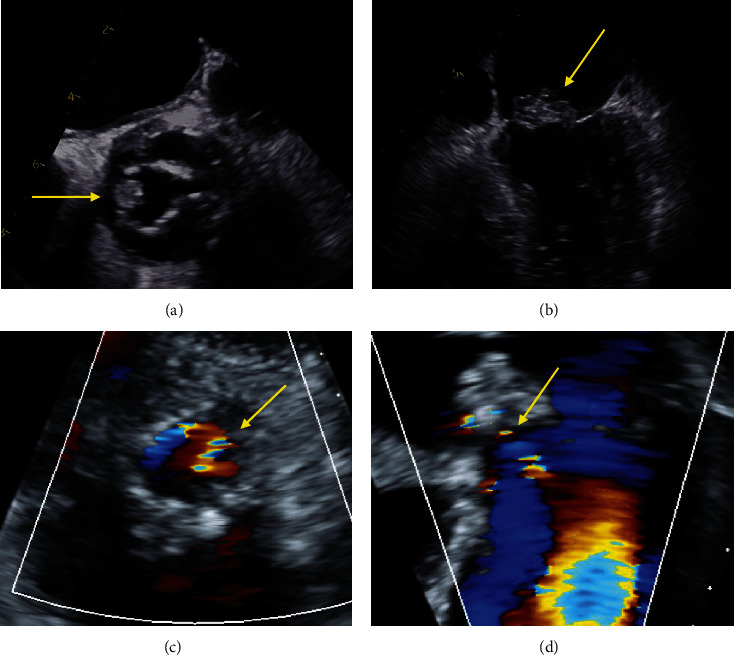Leveraging Color M-Mode to Diagnose Aorto-Atrial Fistula as a Complication of Infective Endocarditis.