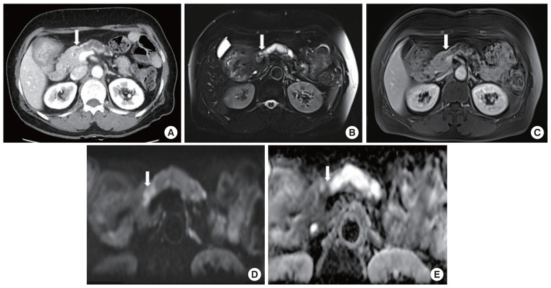 Clinical course of pancreas cancer diagnosed after spleen-preserving distal pancreatectomy with borderline lesion: two case reports.