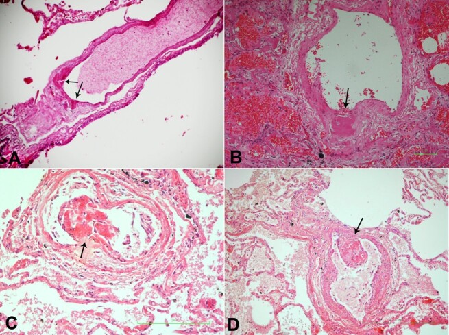 Thrombosis of the vasa vasorum of the large and medium size pulmonary artery and vein leads to pulmonary thromboembolism in COVID-19.